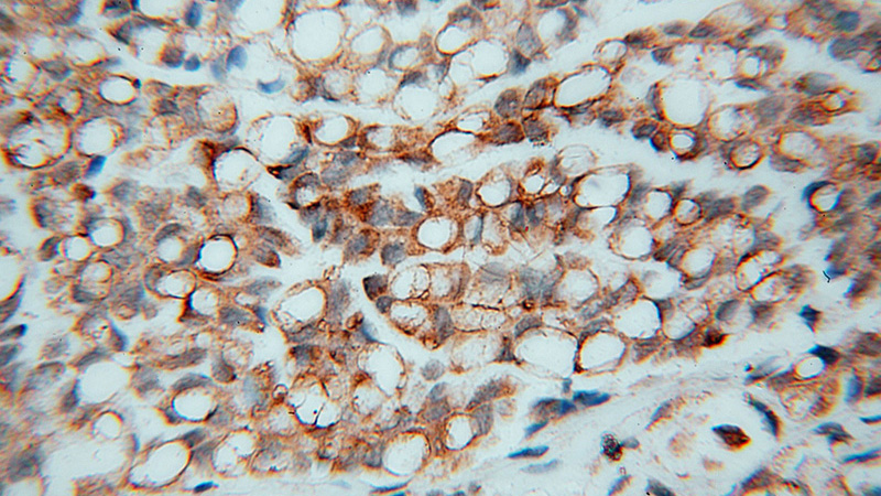 Immunohistochemical of paraffin-embedded human ovary tumor using Catalog No:114382(PSMB2 antibody) at dilution of 1:50 (under 40x lens)
