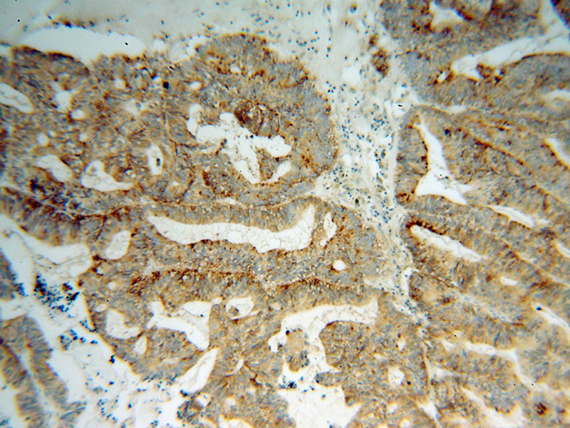 Immunohistochemical of paraffin-embedded human ovary tumor using Catalog No:108126(AP3S2 antibody) at dilution of 1:100 (under 10x lens)
