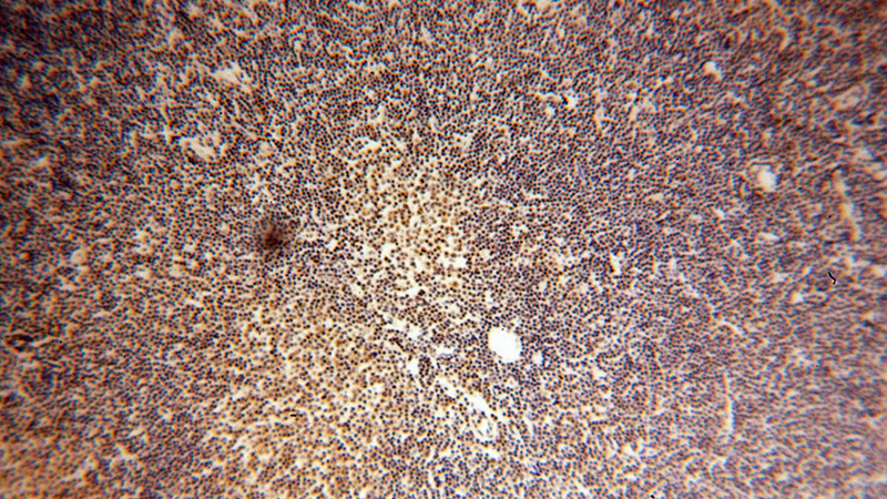 Immunohistochemical of paraffin-embedded human lymphoma using Catalog No:110088(DNAJB1 antibody) at dilution of 1:100 (under 10x lens)