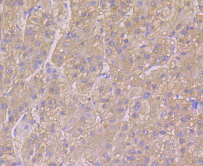 Fig3: Immunohistochemical analysis of paraffin-embedded human liver tissue using anti-Alpha-2-macroglobulin antibody. The section was pre-treated using heat mediated antigen retrieval with sodium citrate buffer (pH 6.0) for 20 minutes. The tissues were blocked in 5% BSA for 30 minutes at room temperature, washed with ddH2O and PBS, and then probed with the antibody at 1/50 dilution, for 30 minutes at room temperature and detected using an HRP conjugated compact polymer system. DAB was used as the chrogen. Counter stained with hematoxylin and mounted with DPX.