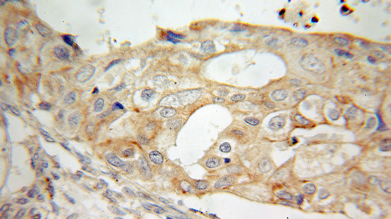 Immunohistochemical of paraffin-embedded human breast cancer using Catalog No:113702(PCDHGC3 antibody) at dilution of 1:100 (under 10x lens)