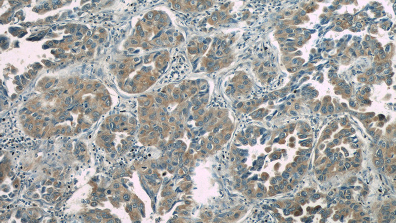 Immunohistochemistry of paraffin-embedded human lung cancer slide using Catalog No:108953(CC2D2A Antibody) at dilution of 1:50(under 10x lens)