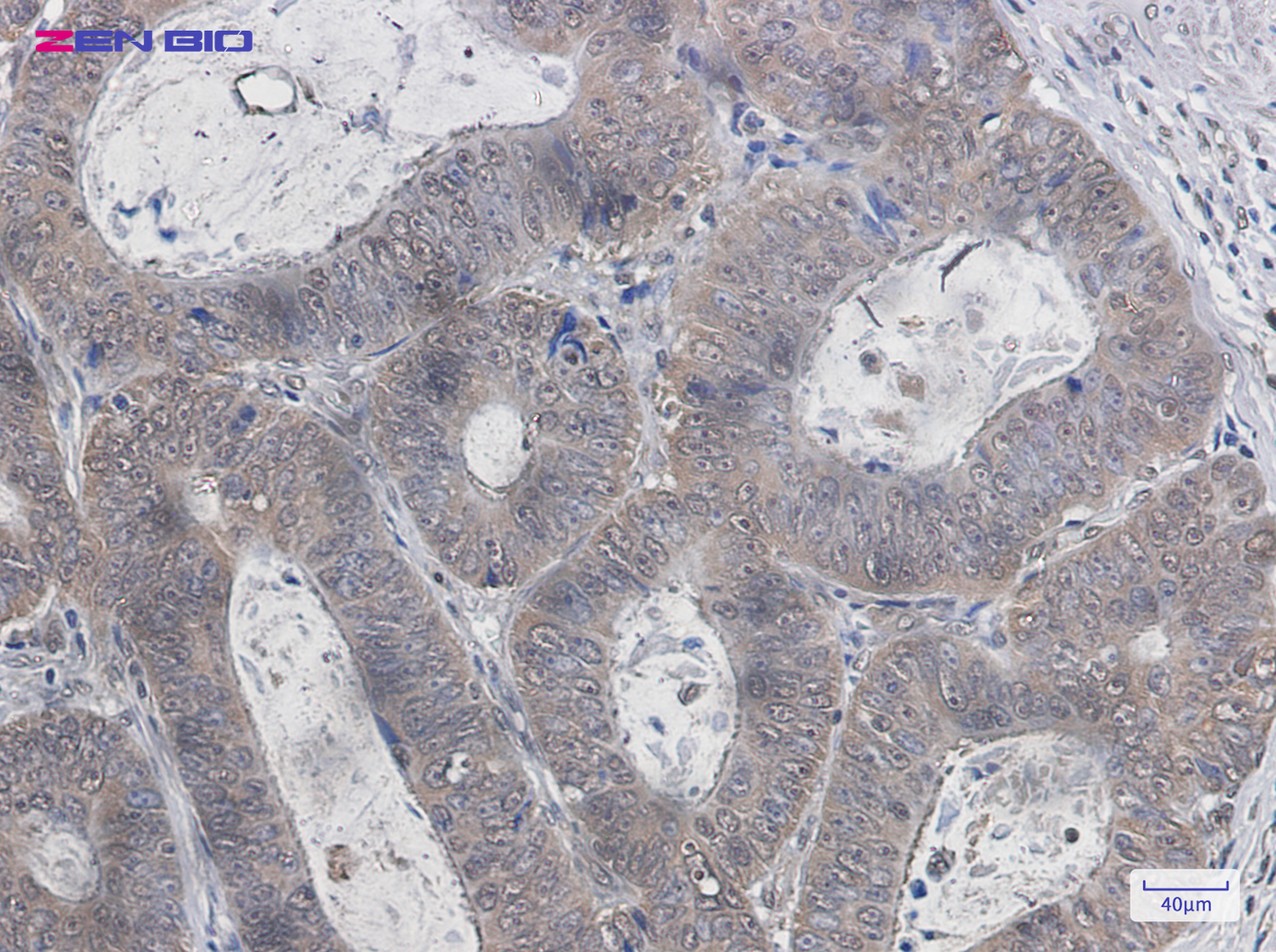 Immunohistochemistry of K-48 Linkage Specific Ubiquitin in paraffin-embedded Human colon cancer tissue using K-48 Linkage Specific Ubiquitin Rabbit pAb at dilution 1/50