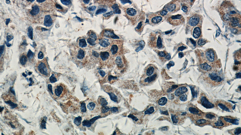 Immunohistochemical of paraffin-embedded human breast cancer using Catalog No:107947(AKT1 antibody) at dilution of 1:50 (under 40x lens)
