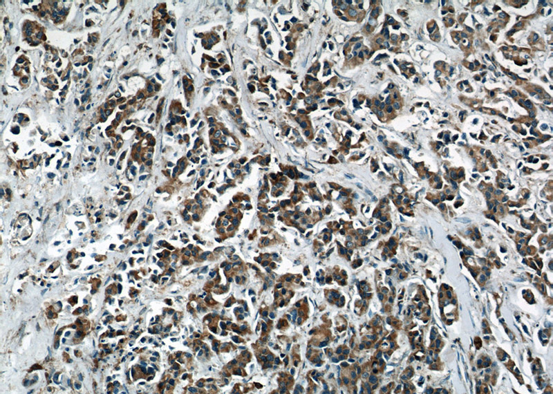 Immunohistochemical of paraffin-embedded human breast cancer using Catalog No:114101(PPP2R2C antibody) at dilution of 1:50 (under 10x lens)