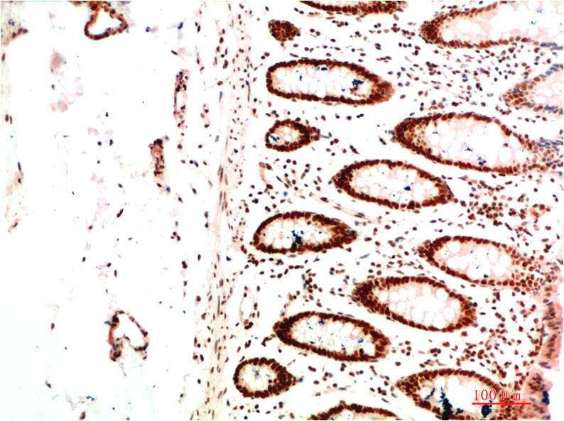 Immunohistochemical analysis of paraffin-embedded Human Colon Carcinoma Tissue using HP-1α  Mouse mAb diluted at 1:200.