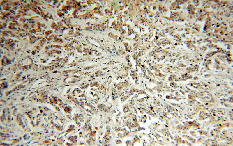 Immunohistochemical of paraffin-embedded human breast cancer using Catalog No:115630(ST6GALNAC5 antibody) at dilution of 1:100 (under 10x lens)