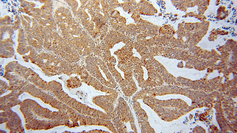Immunohistochemical of paraffin-embedded human ovary tumor using Catalog No:112201(LETM1 antibody) at dilution of 1:100 (under 10x lens)