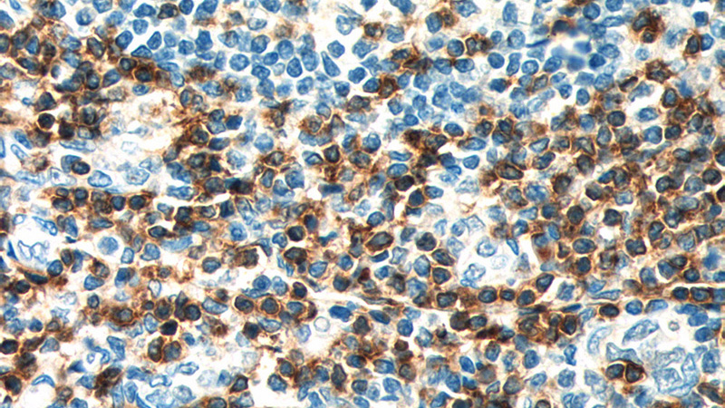 Immunohistochemistry of paraffin-embedded human tonsillitis tissue slide using Catalog No:107129(CD3E Antibody) at dilution of 1:200 (under 40x lens). heat mediated antigen retrieved with Tris-EDTA buffer(pH9).