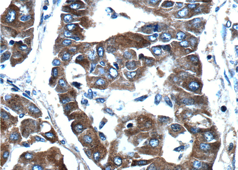 Immunohistochemistry of paraffin-embedded human liver cancer tissue slide using Catalog No:109728(CTPS Antibody) at dilution of 1:100 (under 40x lens).