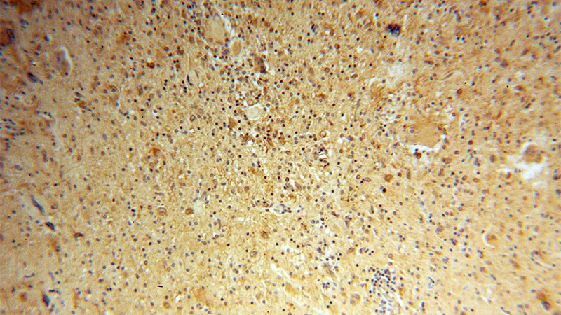 Immunohistochemical of paraffin-embedded human gliomas using Catalog No:111880(JAKMIP1 antibody) at dilution of 1:100 (under 10x lens)