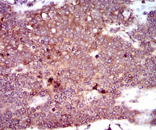Fig6: Immunohistochemical analysis of paraffin-embedded human ovarian cancer tissue using anti-DCTN4 antibody. Counter stained with hematoxylin.