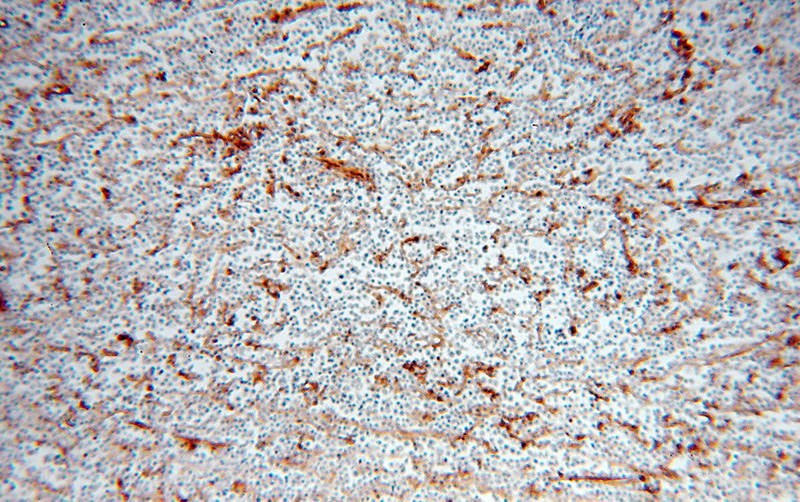 Immunohistochemical of paraffin-embedded human lymphoma using Catalog No:111416(HLA class I (HLA-C) antibody) at dilution of 1:50 (under 10x lens)
