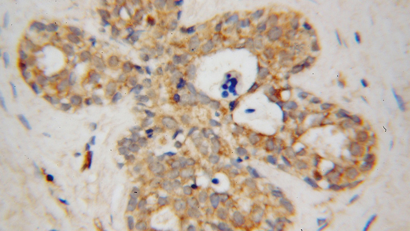 Immunohistochemical of paraffin-embedded human breast cancer using Catalog No:111278(HCCS antibody) at dilution of 1:100 (under 40x lens)