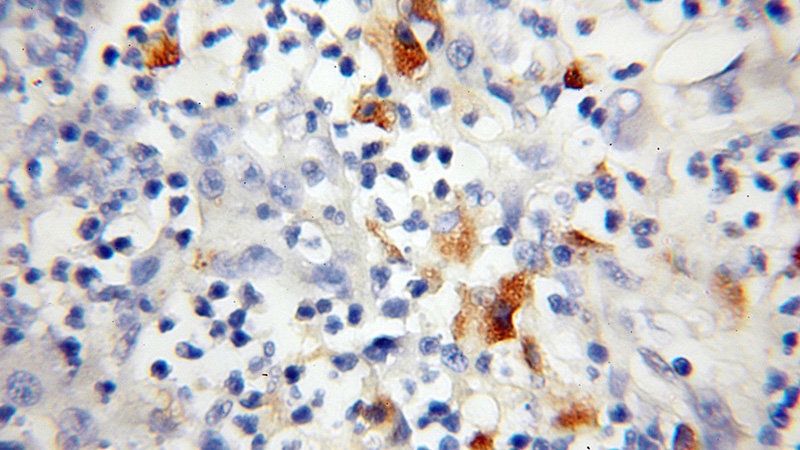 Immunohistochemical of paraffin-embedded human colon cancer using Catalog No:116240(TOMM34 antibody) at dilution of 1:100 (under 10x lens)