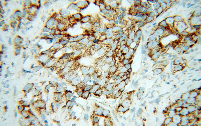 Immunohistochemical of paraffin-embedded human gliomas using Catalog No:113984(PNPT1 antibody) at dilution of 1:100 (under 40x lens)