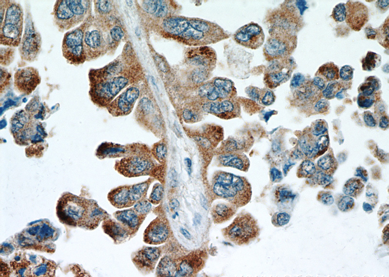 Immunohistochemical of paraffin-embedded human lung cancer using Catalog No:108410(BAGE4 antibody) at dilution of 1:50 (under 40x lens)