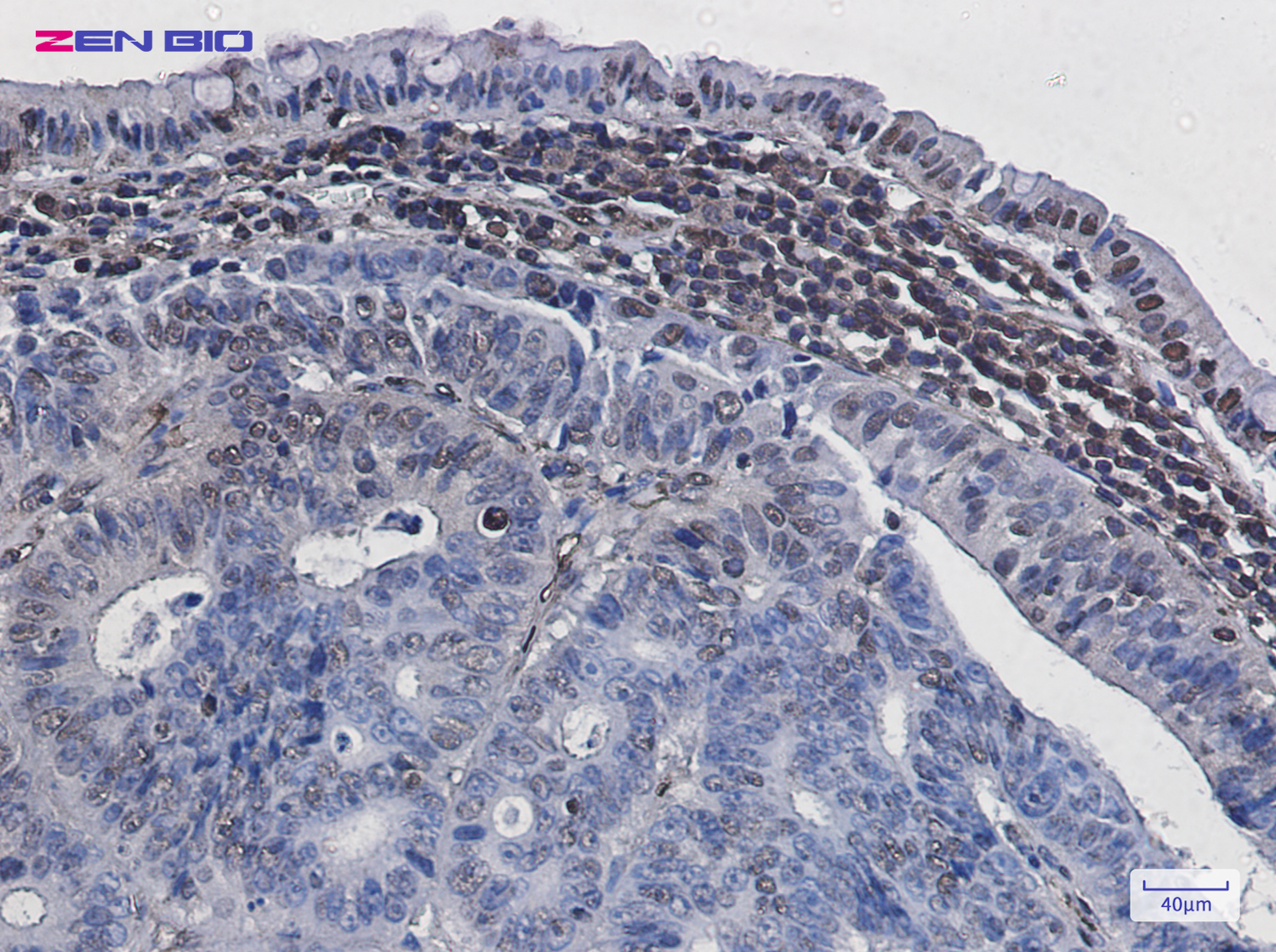 Immunohistochemistry of Histone H3 (Phospho-Ser28) in paraffin-embedded Human colon cancer tissue using Histone H3 (Phospho-Ser28) Rabbit pAb at dilution 1/50