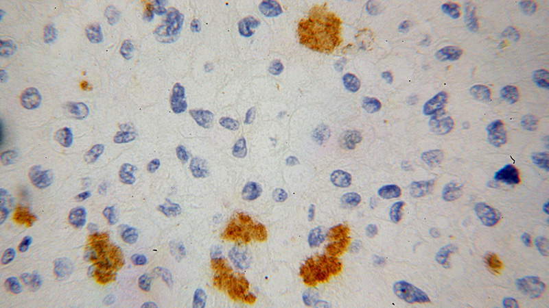 Immunohistochemical of paraffin-embedded human liver cancer using Catalog No:108057(ANGPTL3 antibody) at dilution of 1:100 (under 40x lens)