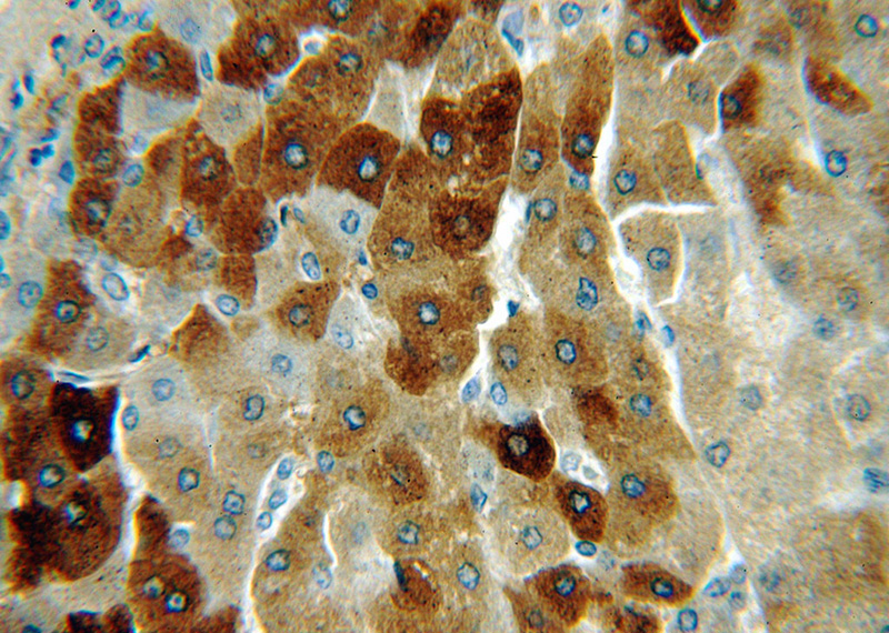 Immunohistochemical of paraffin-embedded human hepatocirrhosis using Catalog No:116114(THUMPD3 antibody) at dilution of 1:100 (under 40x lens)