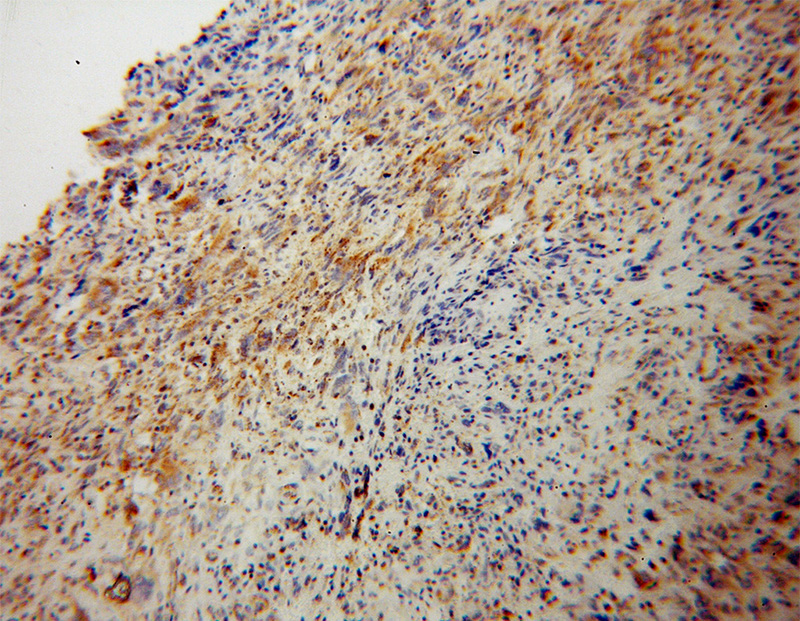 Immunohistochemical of paraffin-embedded human gliomas using Catalog No:113095(NEDD1 antibody) at dilution of 1:100 (under 10x lens)
