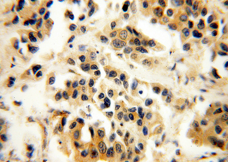 Immunohistochemical of paraffin-embedded human breast cancer using Catalog No:114075(P11 antibody) at dilution of 1:100 (under 40x lens)