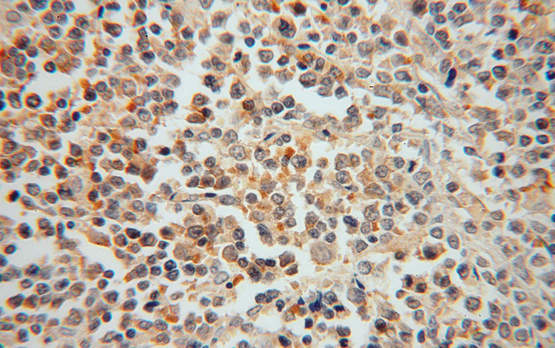 Immunohistochemical of paraffin-embedded human lymphoma using Catalog No:114323(PTPN7 antibody) at dilution of 1:100 (under 40x lens)