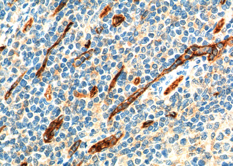 Immunohistochemistry of paraffin-embedded human tonsillitis tissue slide using Catalog No:107132(CD34 Antibody) at dilution of 1:800 (under 40x lens). heat mediated antigen retrieved with Tris-EDTA buffer(pH9).