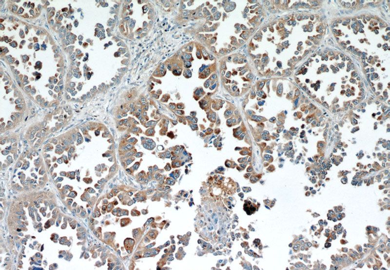 Immunohistochemical of paraffin-embedded human lung cancer using Catalog No:108410(BAGE4 antibody) at dilution of 1:50 (under 10x lens)
