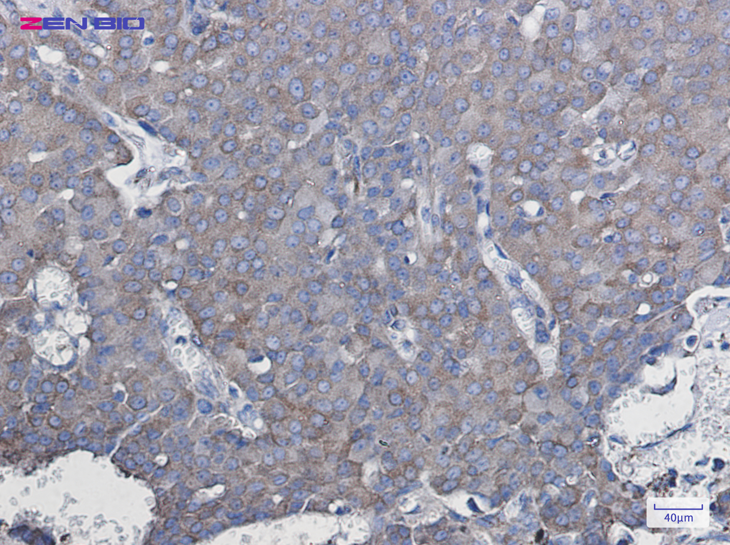 Immunohistochemistry of NDUFAF5 in paraffin-embedded Human breast cancer tissue using NDUFAF5 Rabbit pAb at dilution 1/50