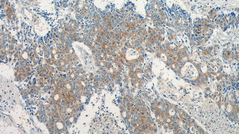 Immunohistochemistry of paraffin-embedded human colon cancer tissue slide using Catalog No:111823(IQCK Antibody) at dilution of 1:50 (under 10x lens)