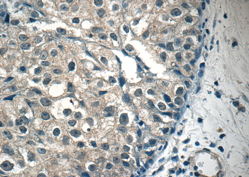 Immunohistochemistry of paraffin-embedded human breast cancer tissue slide using Catalog No:115684(STAT1 Antibody) at dilution of 1:50 (under 40x lens)