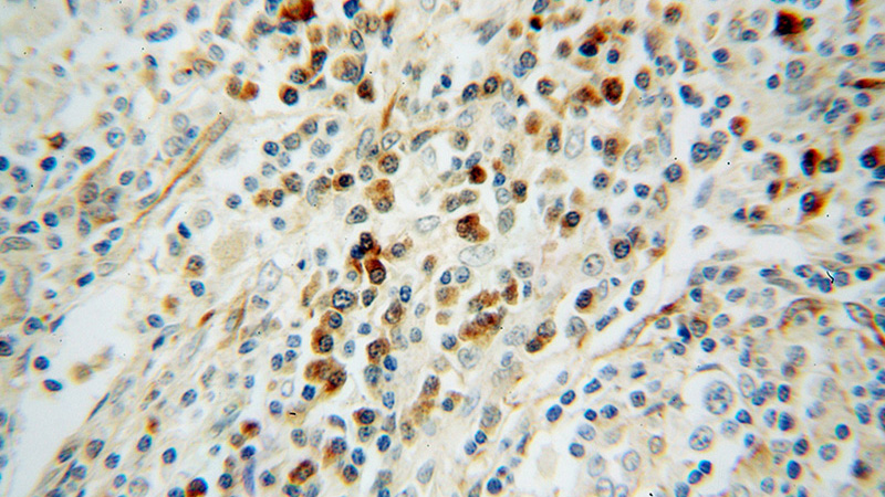 Immunohistochemical of paraffin-embedded human lymphoma using Catalog No:113816(PHGDH antibody) at dilution of 1:100 (under 40x lens)