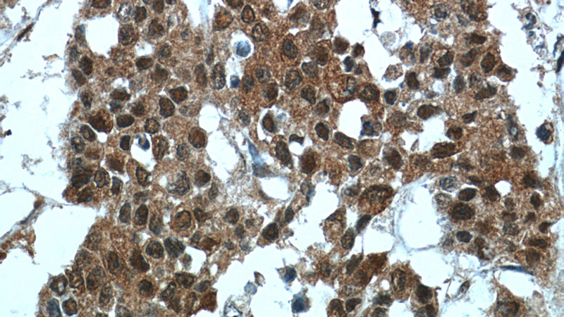 Immunohistochemistry of paraffin-embedded human colon cancer tissue slide using Catalog No:115051(SAMD14 Antibody) at dilution of 1:50 (under 40x lens)