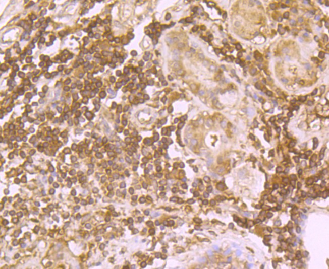 Fig6: Immunohistochemical analysis of paraffin-embedded human lung cancer tissue using anti-PRTN3 antibody. Counter stained with hematoxylin.