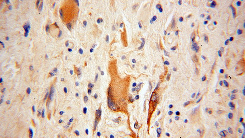 Immunohistochemical of paraffin-embedded human gliomas using Catalog No:108059(ANGPTL5 antibody) at dilution of 1:100 (under 40x lens)
