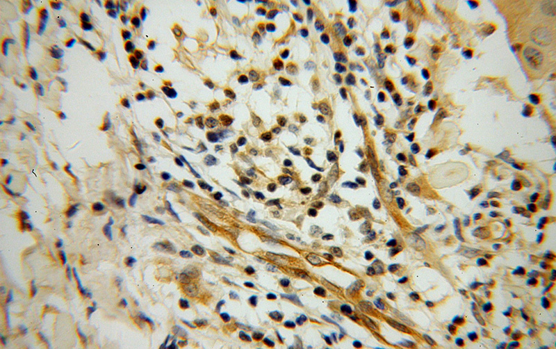 Immunohistochemical of paraffin-embedded human cervical cancer using Catalog No:115690(STAT4 antibody) at dilution of 1:100 (under 40x lens)