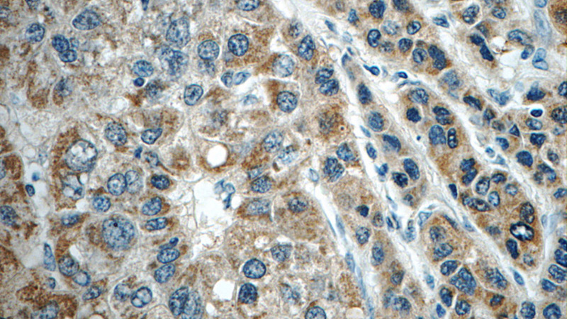 Immunohistochemistry of paraffin-embedded human liver cancer tissue slide using Catalog No:108644(C11orf74 Antibody) at dilution of 1:50 (under 40x lens)