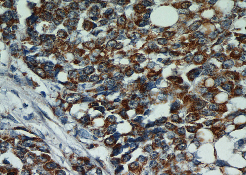 Immunohistochemical of paraffin-embedded human colon cancer using Catalog No:113113(NELL2 antibody) at dilution of 1:50 (under 40x lens)