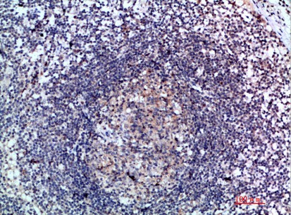 Fig1:; Immunohistochemical analysis of paraffin-embedded human-lymph, antibody was diluted at 1:200