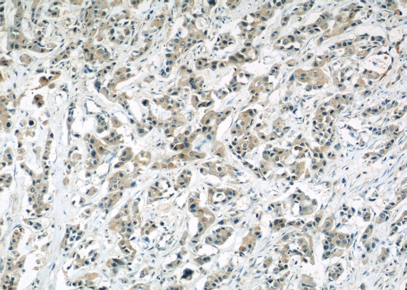 Immunohistochemical of paraffin-embedded human breast cancer using Catalog No:107418(MCL1 antibody) at dilution of 1:50 (under 10x lens)