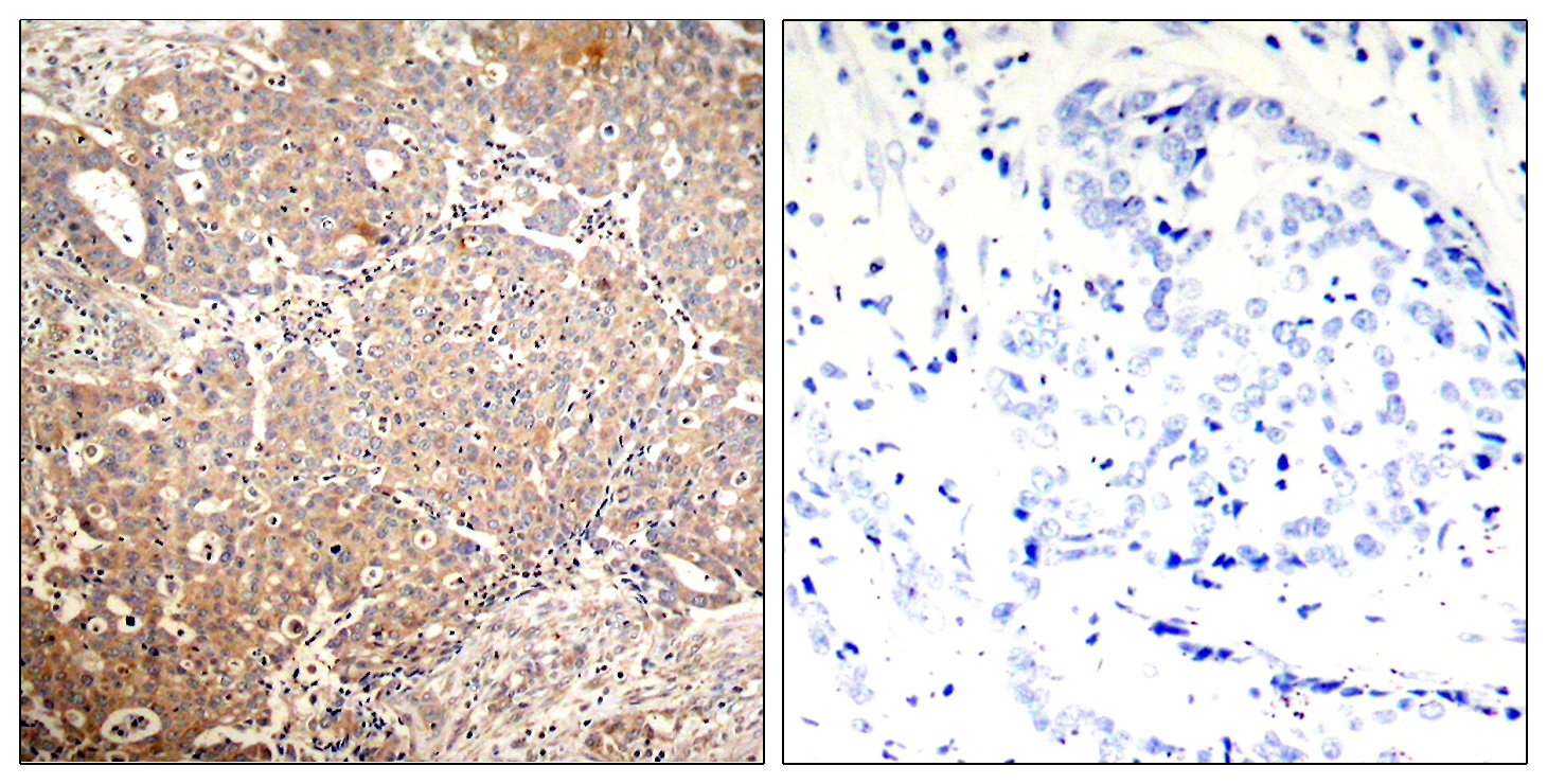 Immunohistochemical analysis of paraffin-embedded human breast carcinoma tissue using Keratin 18 (Phospho-Ser33) Antibody (left) or the same antibody preincubated with blocking peptide (right).