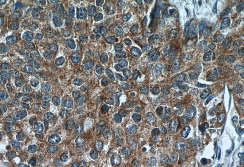 Immunohistochemistry of paraffin-embedded human cervical cancer tissue slide using Catalog No:114755(RNF25 Antibody) at dilution of 1:50 (under 40x lens)