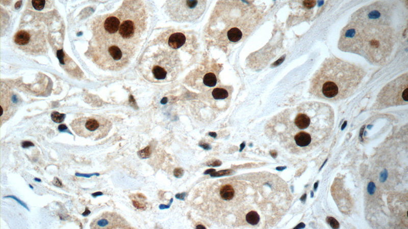 Immunohistochemistry of paraffin-embedded human breast cancer slide using Catalog No:113139(NF45 Antibody) at dilution of 1:100