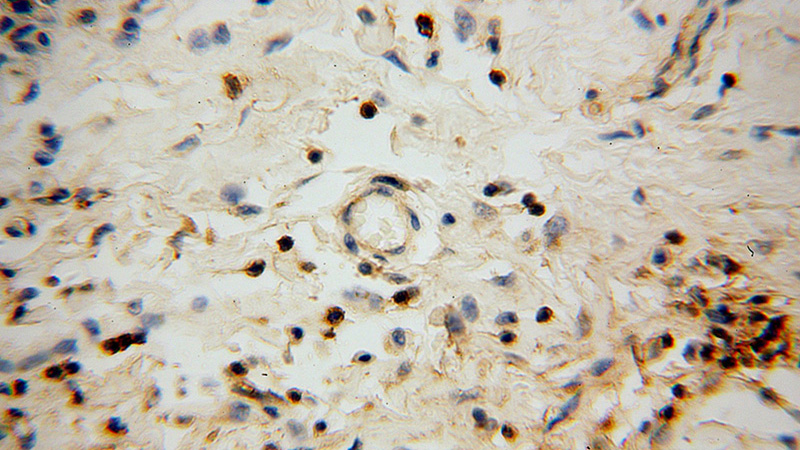Immunohistochemical of paraffin-embedded human skin cancer using Catalog No:111430(HLA-F antibody) at dilution of 1:100 (under 40x lens)
