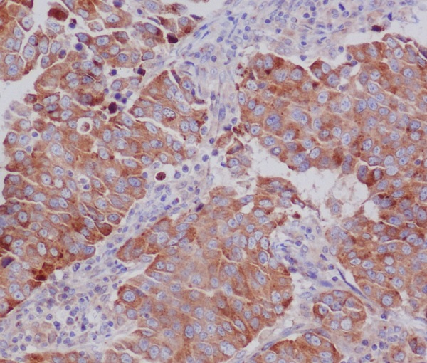Immunohistochemical analysis of paraffin-embedded human breast cancer, using PUMA Antibody.