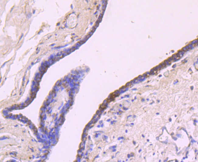 Fig8:; Immunohistochemical analysis of paraffin-embedded human breast carcinoma tissue using anti-IGF2 antibody. The section was pre-treated using heat mediated antigen retrieval with Tris-EDTA buffer (pH 9.0) for 20 minutes.The tissues were blocked in 1% BSA for 30 minutes at room temperature, washed with ddH; 2; O and PBS, and then probed with the primary antibody ( 1/50) for 30 minutes at room temperature. The detection was performed using an HRP conjugated compact polymer system. DAB was used as the chromogen. Tissues were counterstained with hematoxylin and mounted with DPX.
