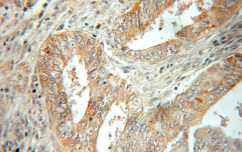 Immunohistochemical of paraffin-embedded human ovary tumor using Catalog No:112092(KLHL14 antibody) at dilution of 1:50 (under 10x lens)