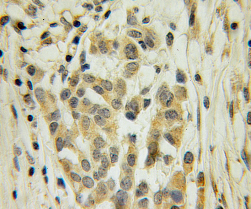 Immunohistochemical of paraffin-embedded human breast cancer using Catalog No:111717(ELAVL4 antibody) at dilution of 1:100 (under 10x lens)
