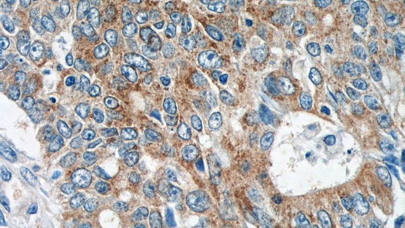 Immunohistochemistry of paraffin-embedded human colon cancer tissue slide using Catalog No:111823(IQCK Antibody) at dilution of 1:50 (under 40x lens)